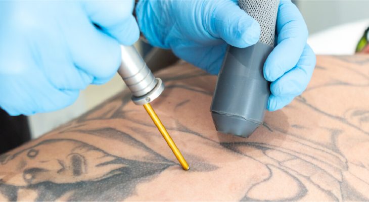 tattoo removal scarring