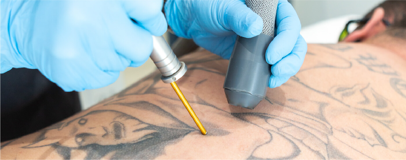 tattoo removal scarring