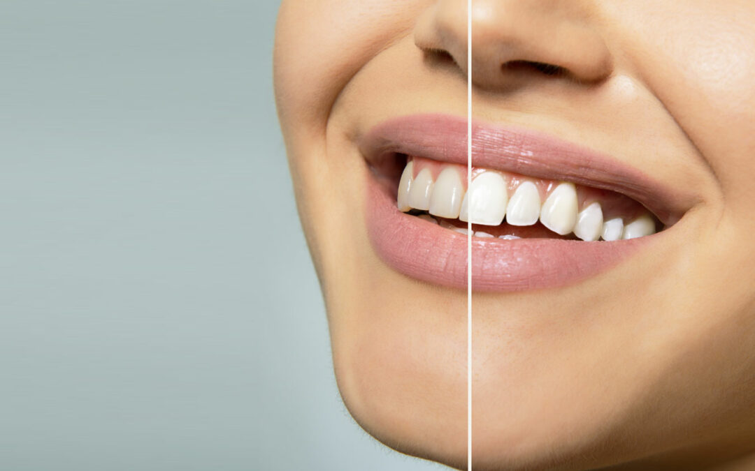 How Seasonal Changes Affect Your Teeth Whitening Maintenance Routine