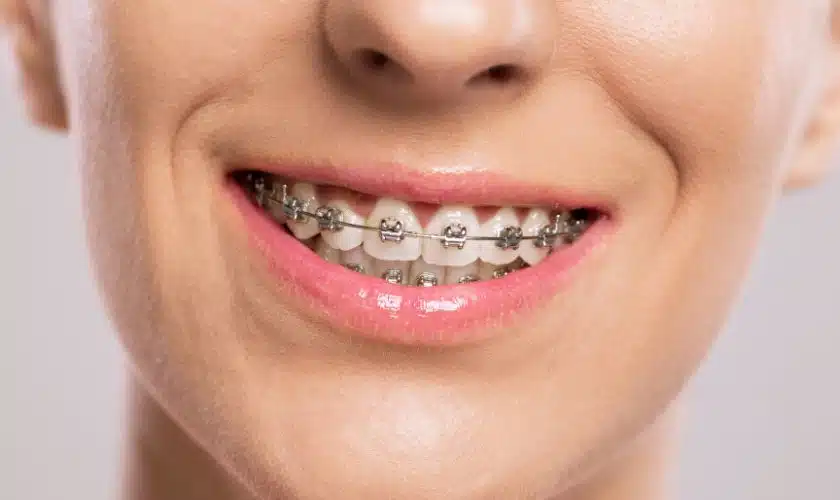 Invisible Braces: How Invisalign Enhances Oral Health Beyond Aesthetics